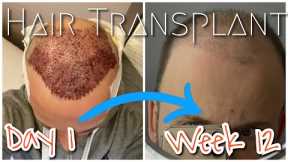 Week 12 Update New Hair Growing, Timelapse, Hair Transplant Turkey 2020