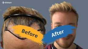 Hair Transplant Before and After - hair transplant time lapse