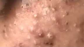 Huge Acne Pimples Blackheads Popping Up Satisfying with Oddly Calm Music