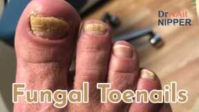 Fungal Toenails. FEET-ure Friday (2022)