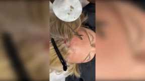 Popping huge blackheads and Pimple Popping - Best Pimple Popping Videos