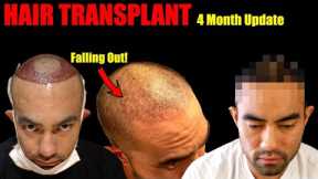 My Hair Transplant Results After 4 Months | Hair Falling Out