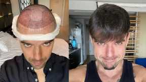 Hair Transplant Results With Pictures | 1 Year Transformation | Alain Bruno