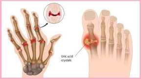 7 Natural Remedies for Arthritis Pain Relief