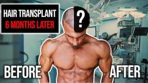 Hair Transplant Results After 6 Months | Before & After