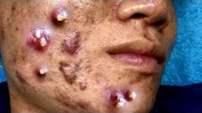 Cystic Acne Extraction Big Blackheads Removal Relaxing HD Quality #1