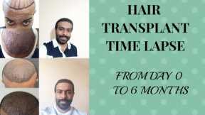 Hair transplant - time lapse Day 0 to 6 months