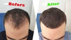 DHI Hair Transplant Results (6 Months Time Lapse)