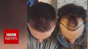 Hair loss: Fighting against my receding hairline  - BBC News