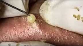 Big Cystic Acne Blackheads Extraction Blackheads & Milia, Whiteheads Removal Pimple Popping