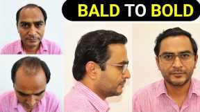 Full Hair Transplant Results 12 Months|Hair growth Timelapse|