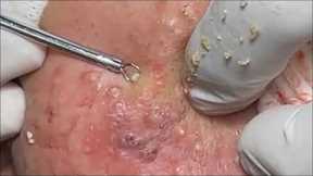 Big Cystic Acne Blackheads Extraction Blackheads & Milia, Whiteheads Removal Pimple Popping