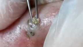Big Cystic Acne Blackheads Extraction Blackheads & Milia, Whiteheads Removal Pimple Popping