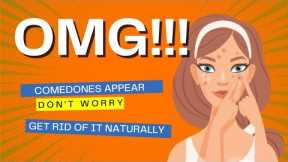 How To Get Rid Of Blackheads With Natural Ingredients ||blackheads removal