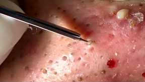 Blackheads & Milia, Big cystic acne blackheads extraction whiteheads Removal Pimple Popping.