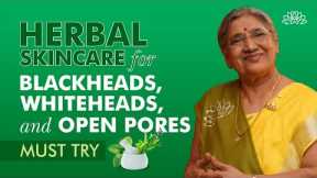 How To Get Rid of Blackheads, Whiteheads, and Open Pores Naturally | Natural Skincare Remedies