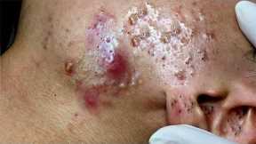 Blackhead removal | pimple remove | pimple popping | pimple popping videos blackheads