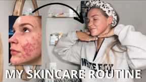 REALISTIC SKINCARE ROUTINE | MY ACCUTANE JOURNEY | OVERCOMING CYSTIC ACNE