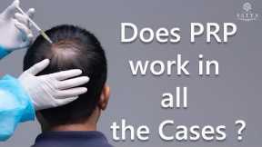 PRP | How many PRP sessions are needed for Hair Growth? PRP Hair | PRP Hair Cost | PRP Result| Satya