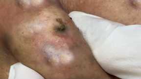 Blackheads & Milia, Big cystic acne blackheads extraction whiteheads Removal Pimple Popping.