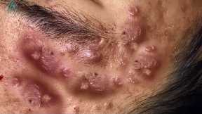 Big Cystic Acne Blackheads Extraction Blackheads & Milia, Whiteheads Removal Pimple Popping
