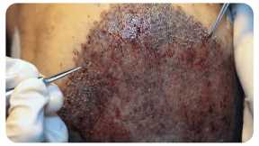 Watch the Full FUE Hair Transplant Procedure in a 60 Second Time Lapse!
