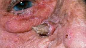 Blackheads & Milia, Big cystic acne blackheads extraction whiteheads Removal Pimple Popping.