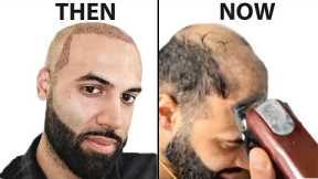 I Shaved My HEAD BALD 4 Years After Hair Transplant | Surgeon Reacts