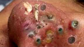 Blackheads & Milia, Big cystic acne blackheads extraction whiteheads Removal Pimple Popping.