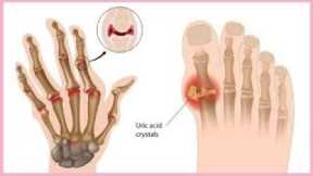🚨 7 Natural Remedies for Arthritis Pain Relief