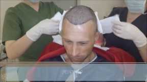 FUE Hair Transplant Growth Timeline - Health Travel International