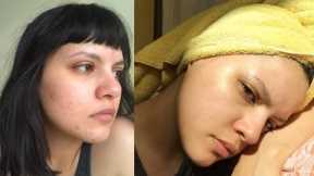 Routine that healed my DRY ACNE PRONE skin!!!