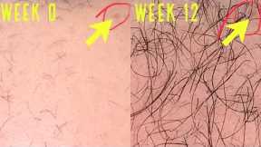 UNBELIEVABLE MICRONEEDLING/DERMA ROLLING RESULTS FOR HAIR GROWTH!