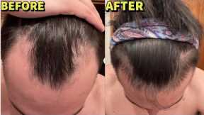 HYPER-RESPONDER ON BIG 3 + MICRONEEDLING HAIR LOSS STACK INSANE 5 MONTH RESULTS!