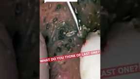 pimple popping 2022 new,  SUPER blackheads REMOVAL, pimple popping tiktok #7889