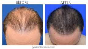 Platelet-Rich Plasma for Hair Loss | PRP Hair Restoration With Microneedling | Beverly Hills, CA
