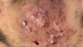 Blackheads & Milia,😱 Big cystic acne blackheads, whiteheads Removal Pimple Popping New This Week.