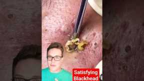 SATISFYING BLACKHEAD REMOVAL - Viewer Be Warned #shorts