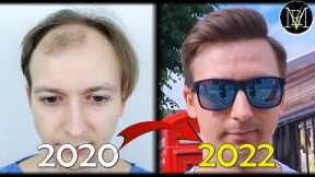How I Regained my Hair BACK!