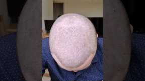 Hair Transplant Growth Timeline #shorts