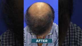✅1st Hair Transplant Results #shorts #hair