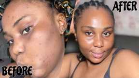 How I Finally Cleared My Acne Prone Skin+Skin Care Routine.