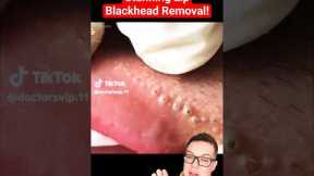 Crazy Painful BLACKHEAD REMOVAL AROUND LIPS - Super Satisfying #shorts