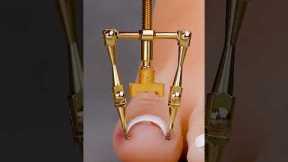 Ingrown toenail gadget hack #shorts