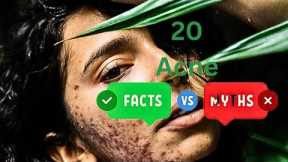 Acne Myths You Might Have Been Told Or Heard That Are Liars