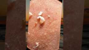 Goodbye to blackheads and pimples: deep skin cleansing steps