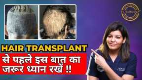 5 Essential Tips to Know Before Considering a Hair Transplant! | Hair Transplant Clinic