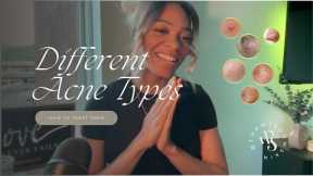 How I Cleared My Acne | Different Types Of Acne | How To Treat Acne | Lifestyle Habits + Tips