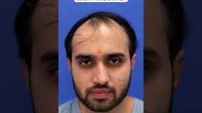 💥Unbelievable Hair Transplant Results by Perfect-i Technique💥 #shorts #shortsfeed #viral