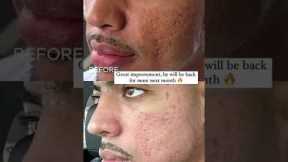 #shorts THE BUILDING PROCESS | ACNE SCAR COMBO FOR SENSITIVE SKIN TYPES | Dr. Jason Emer